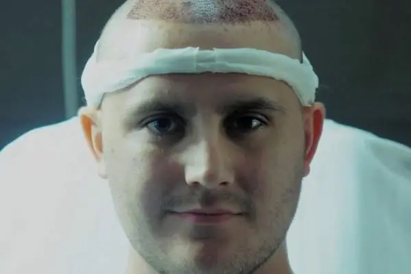 Hair transplant patient